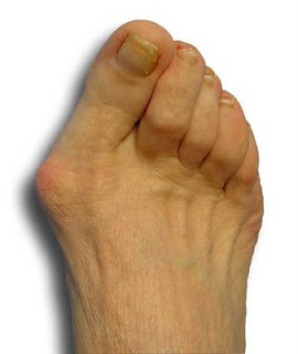 Bunions Callous