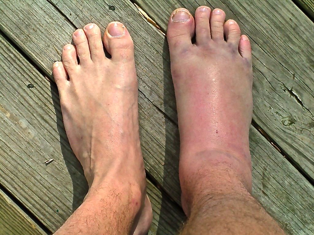 Foot Sprain 89