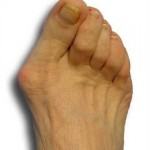 Bunion Pain Indiana https://achillespodiatry.com