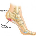 plantar fasciitis indianapolis