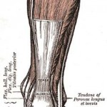 Achilles Tendon Indianapolis