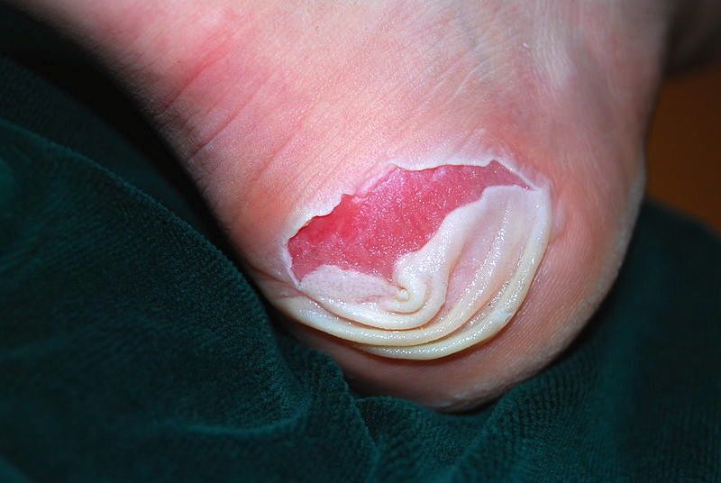 Foot Blister - Achilles Podiatry