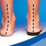 orthotics with and without