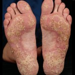  foot psoriasis