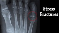 stress fractured foot indianapolis