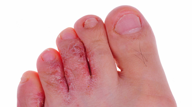 How to Prevent Calluses, Blisters, Athlete's Foot, and Other