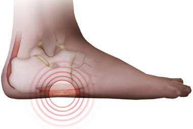 Pain outside of deals achilles tendon